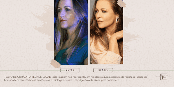 Bioestimulador de colágeno Radiesse: o que é, como funciona e tudo o que você precisa saber